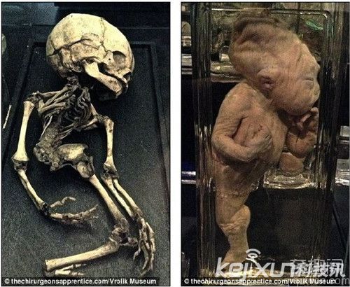 美人鱼传闻太美好  现实系致命性疾病